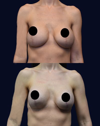 Breast Lift Before & After Gallery - Patient 422234 - Image 1