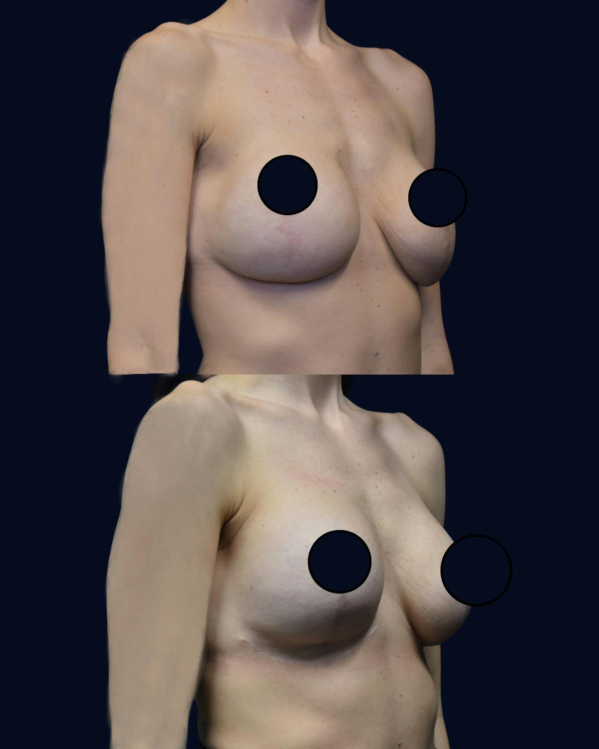 Breast Lift with Implants Before & After Gallery - Patient 151061 - Image 2