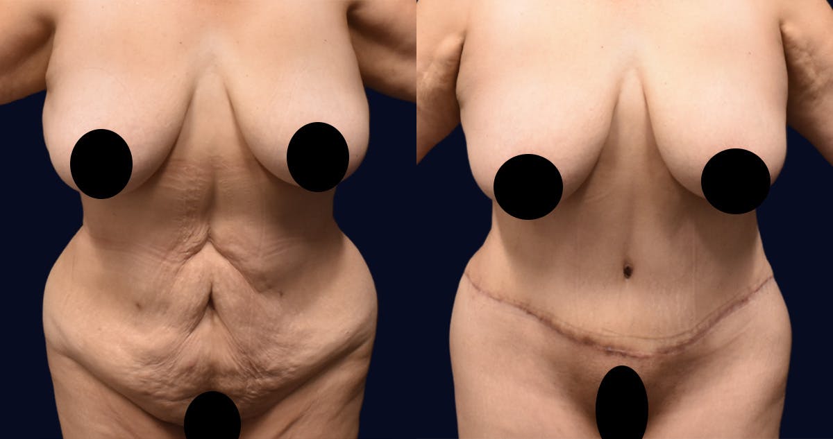 Abdominoplasty (Tummy Tuck) Before & After Gallery - Patient 313070 - Image 1
