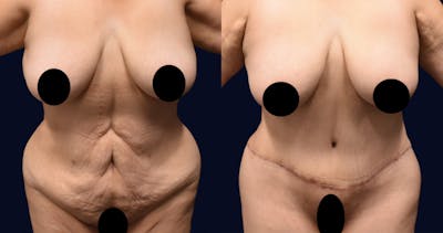 Abdominoplasty (Tummy Tuck) Before & After Gallery - Patient 313070 - Image 1