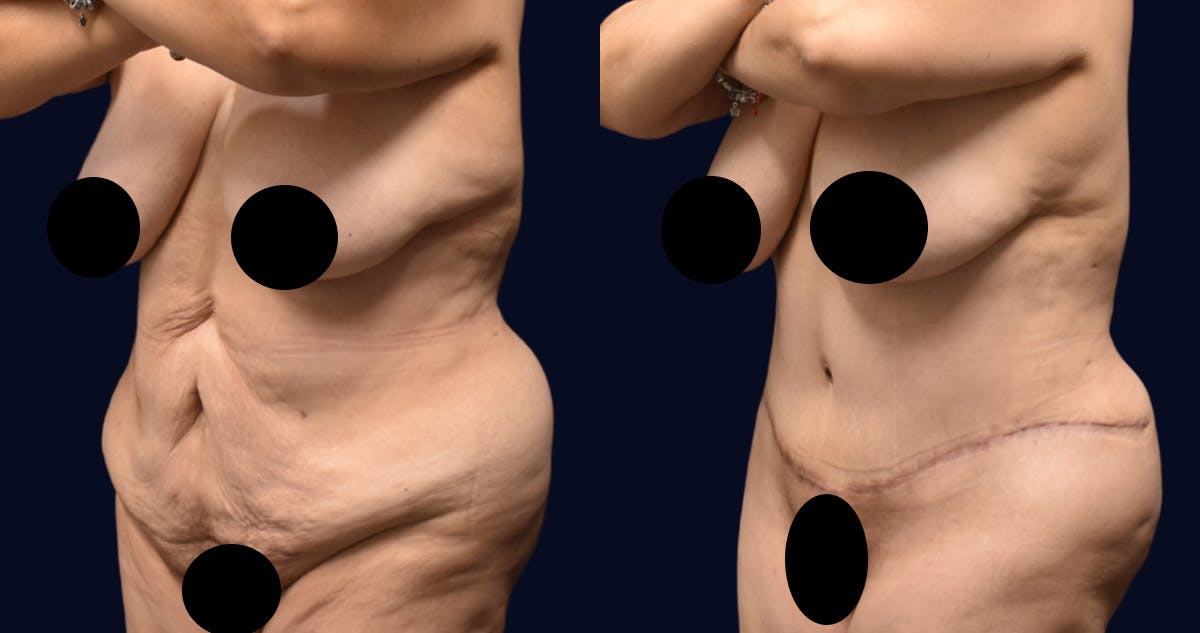 Abdominoplasty (Tummy Tuck) Before & After Gallery - Patient 313070 - Image 2