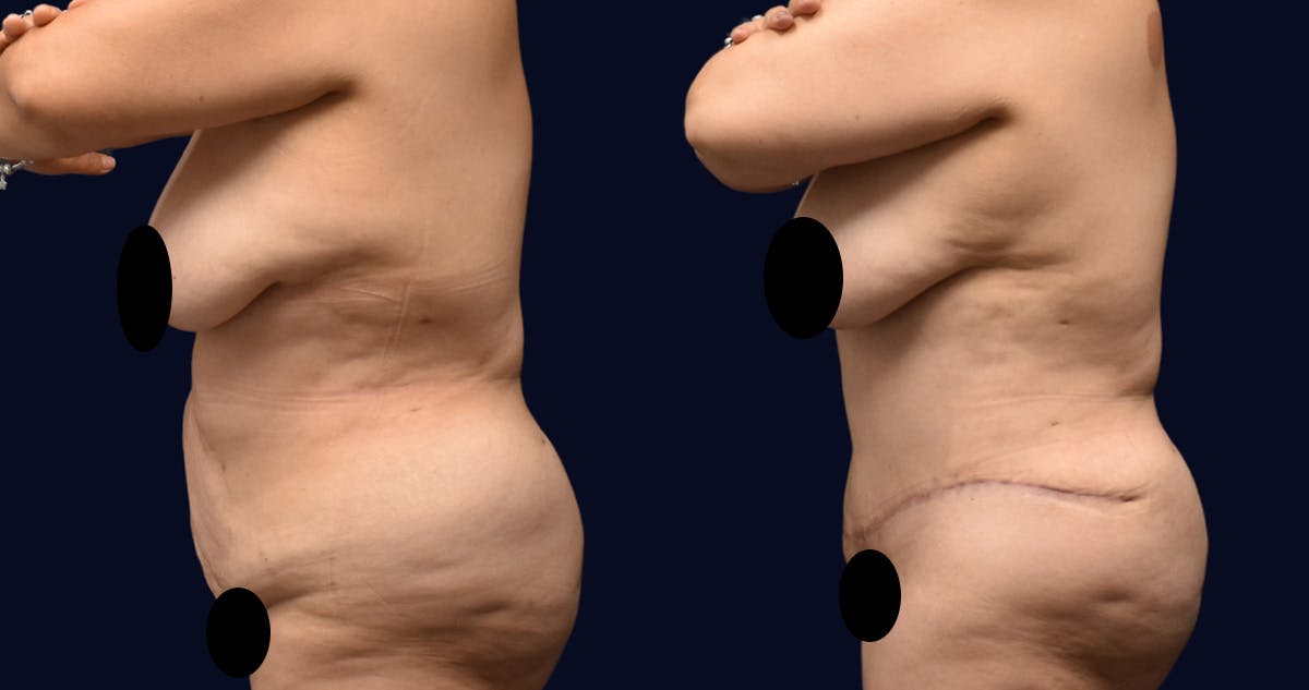 Abdominoplasty (Tummy Tuck) Before & After Gallery - Patient 313070 - Image 3