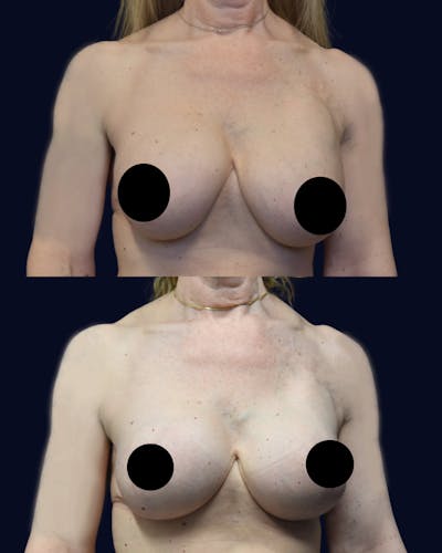 Breast Lift Before & After Gallery - Patient 136573 - Image 1