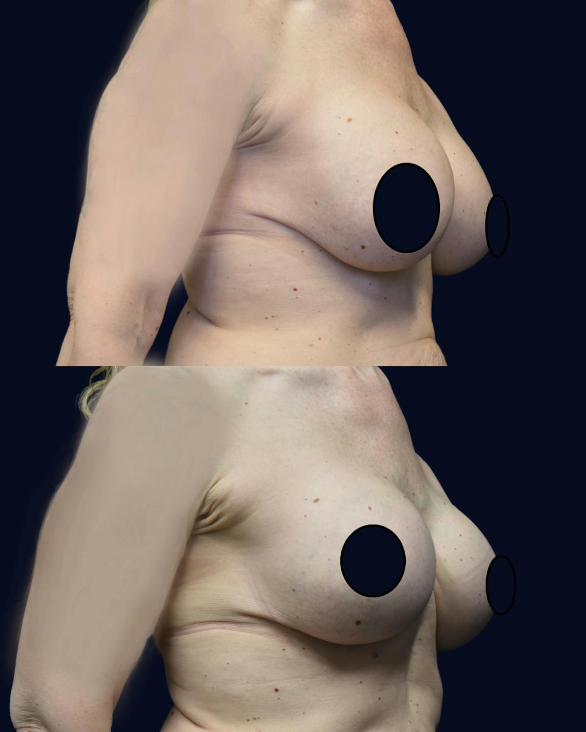 Breast Lift Before & After Gallery - Patient 236150 - Image 2