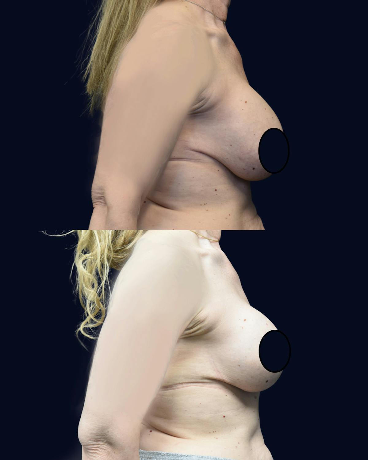 Breast Lift Before & After Gallery - Patient 236150 - Image 3