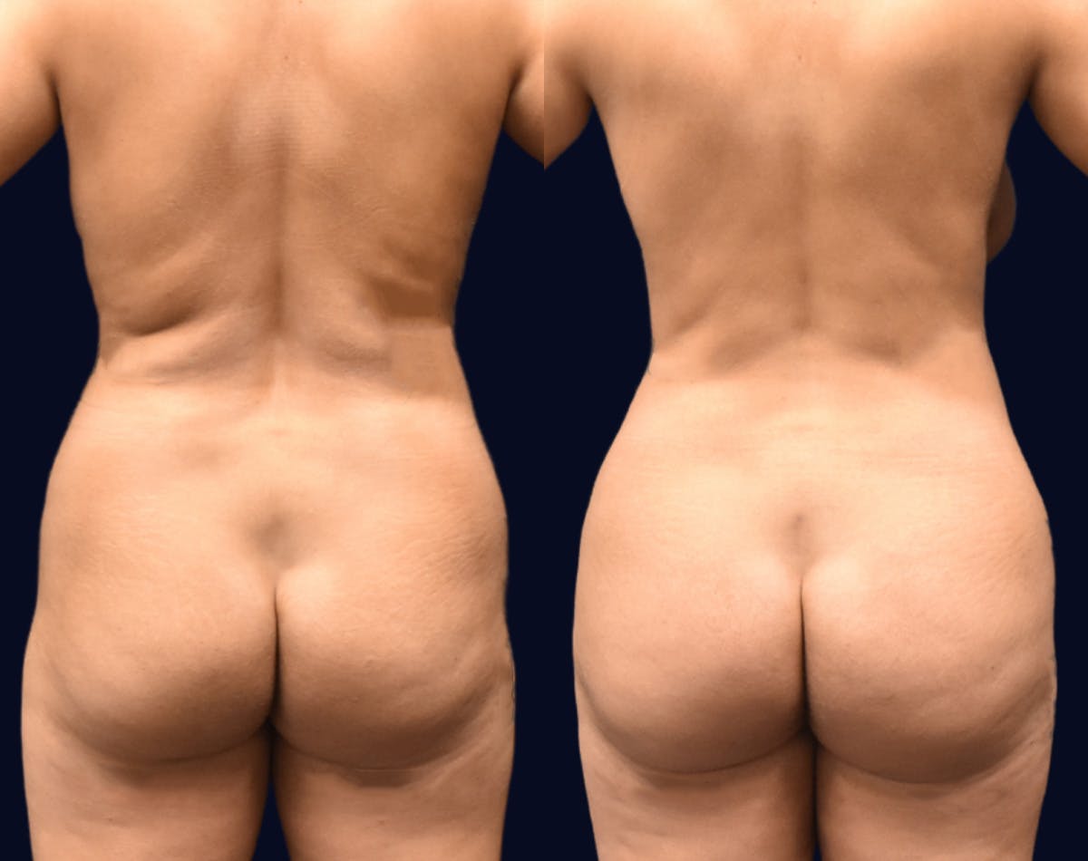 Brazilian Butt Lift Before & After Gallery - Patient 174993 - Image 1