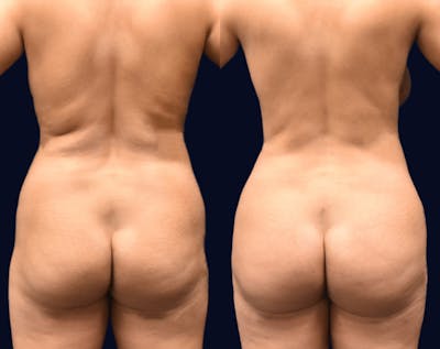 Brazilian Butt Lift Before & After Gallery - Patient 174993 - Image 1