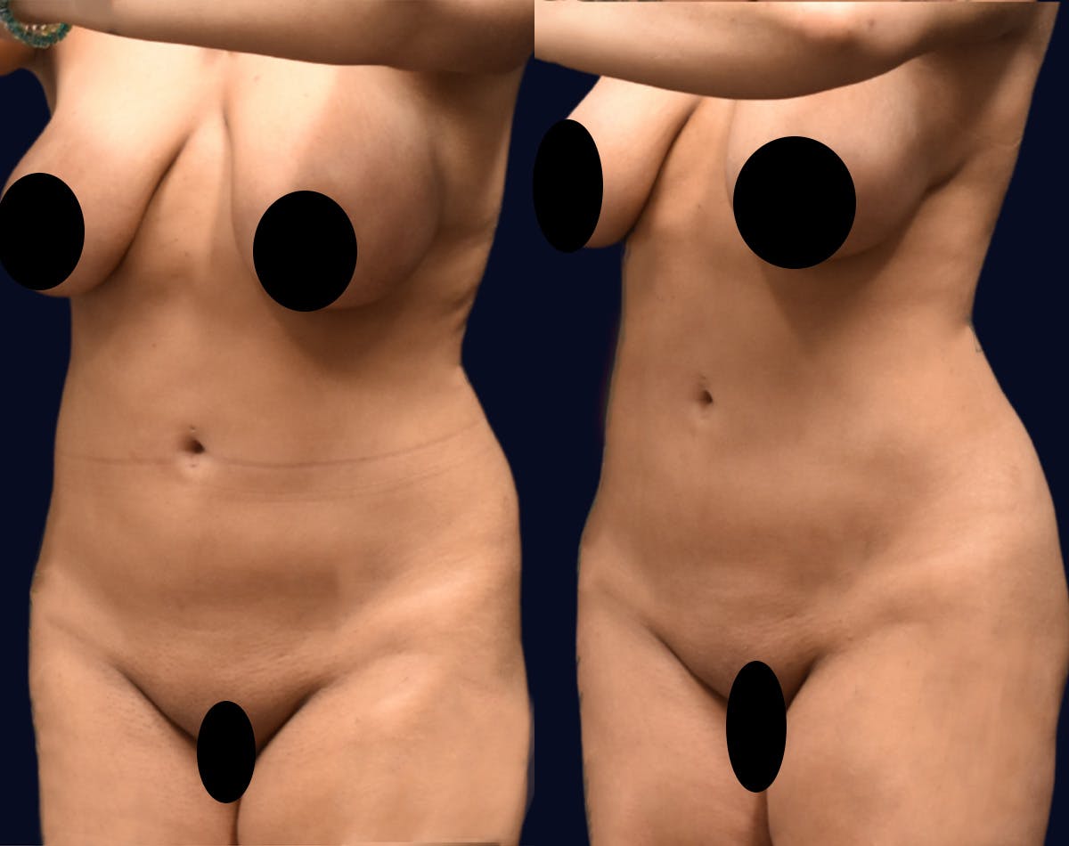 Brazilian Butt Lift Before & After Gallery - Patient 174993 - Image 4