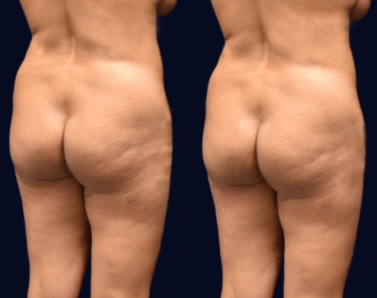 Brazilian Butt Lift Before & After Gallery - Patient 174993 - Image 2