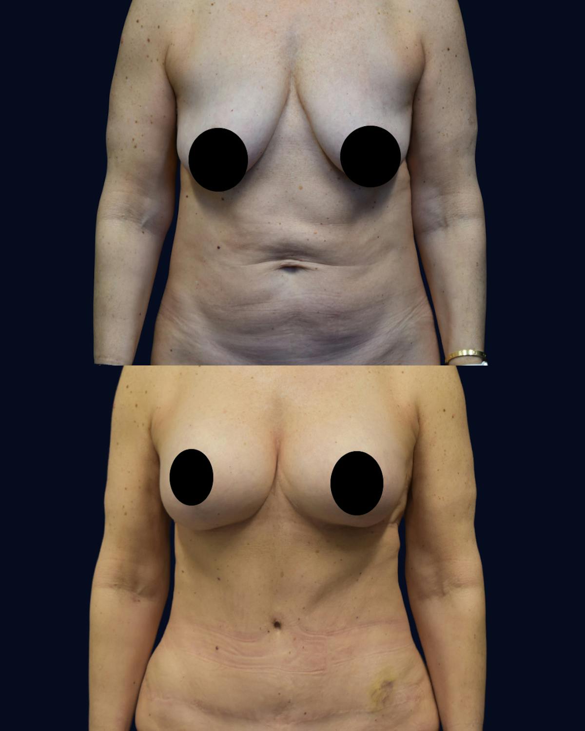 Breast Lift with Implants Before & After Gallery - Patient 938689 - Image 1