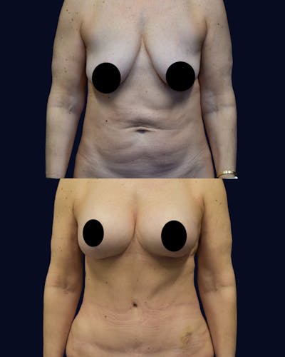 Breast Lift Before & After Gallery - Patient 219952 - Image 1