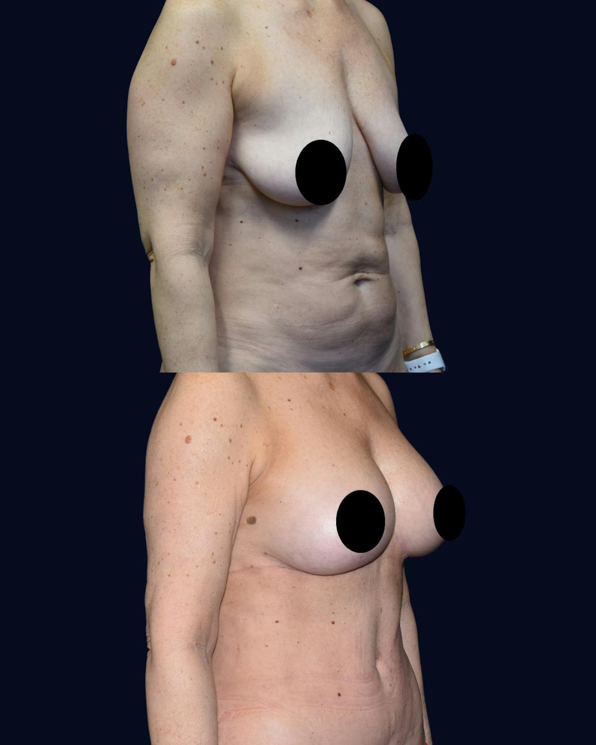 Breast Lift with Implants Before & After Gallery - Patient 938689 - Image 3