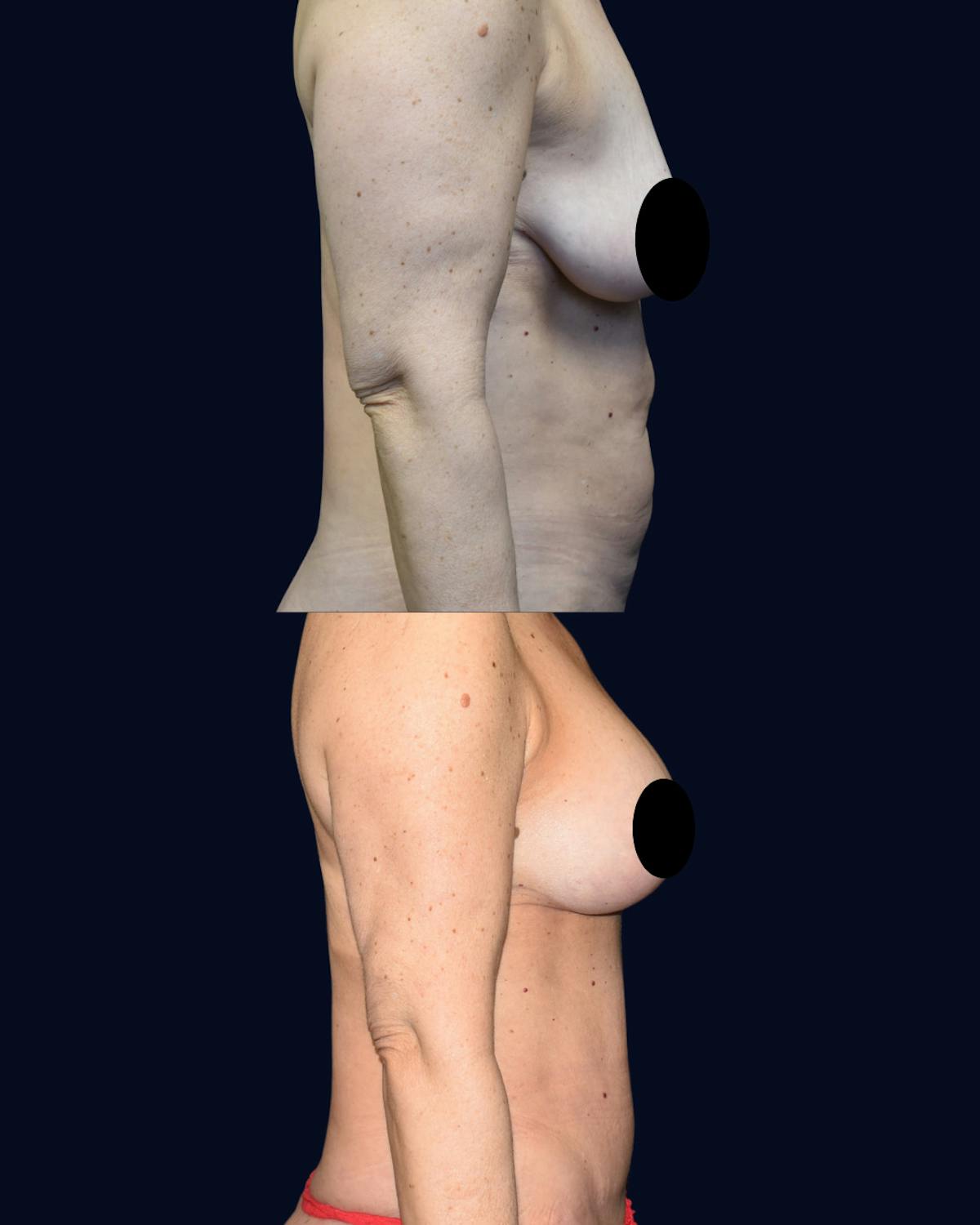 Breast Lift with Implants Before & After Gallery - Patient 938689 - Image 4