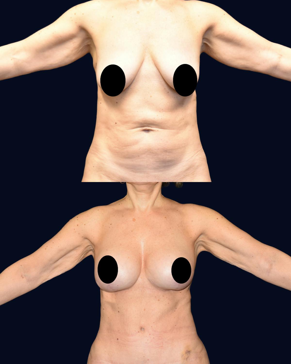 Breast Lift with Implants Before & After Gallery - Patient 938689 - Image 2