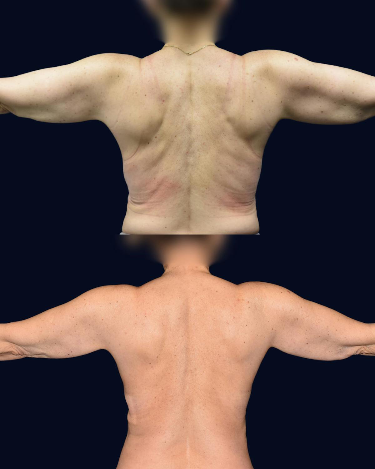 Breast Lift with Implants Before & After Gallery - Patient 938689 - Image 6