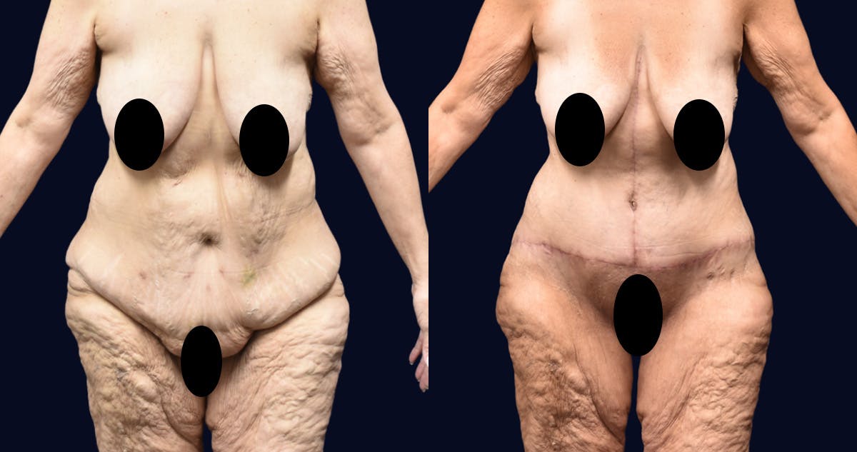 Abdominoplasty (Tummy Tuck) Before & After Gallery - Patient 266774 - Image 1
