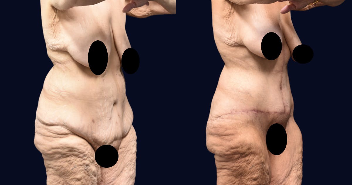 Abdominoplasty (Tummy Tuck) Before & After Gallery - Patient 266774 - Image 2
