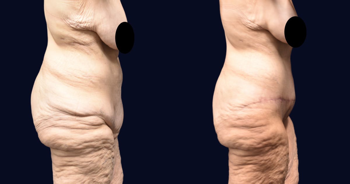 Abdominoplasty (Tummy Tuck) Before & After Gallery - Patient 266774 - Image 3