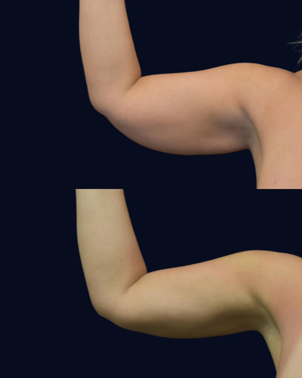 Brachioplasty (Arm Lift) Before & After Gallery - Patient 273993 - Image 1