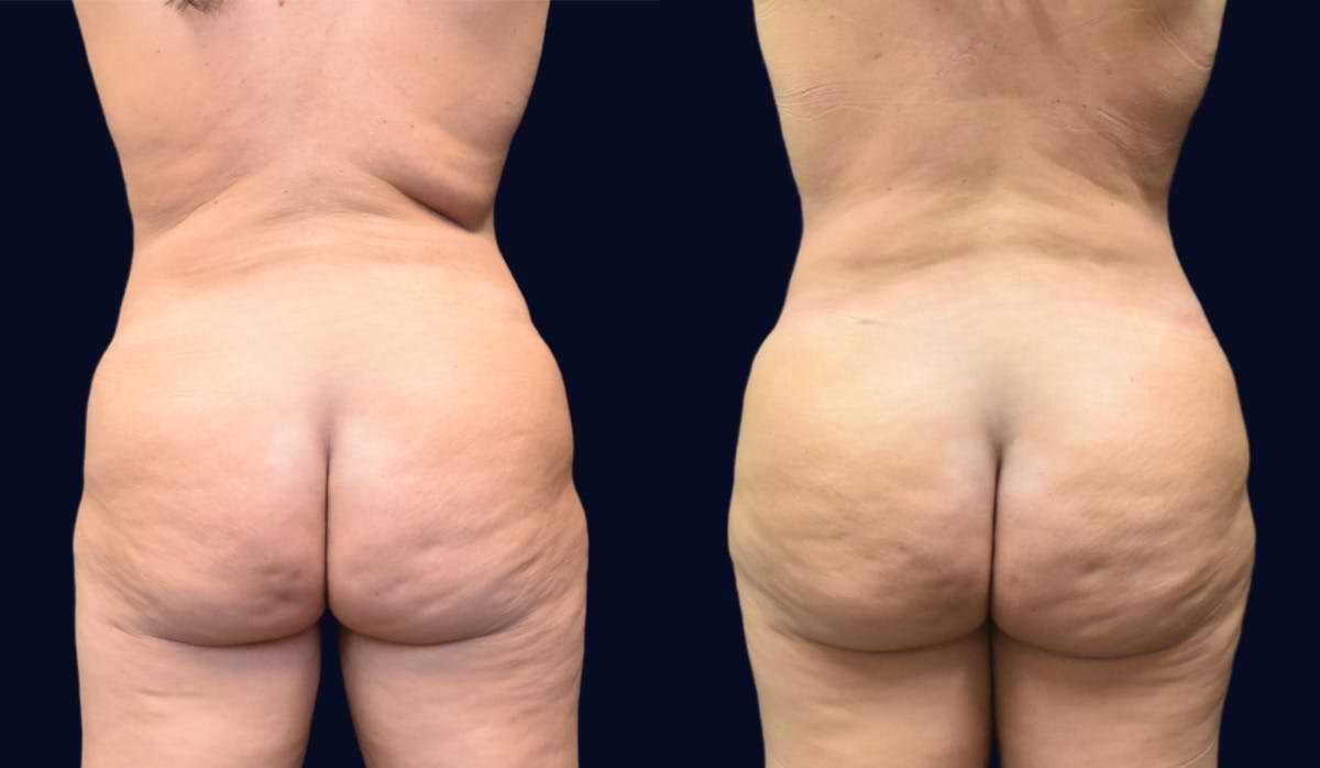 Liposuction Before & After Gallery - Patient 441727 - Image 1