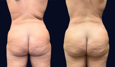 Liposuction Before & After Gallery - Patient 441727 - Image 1