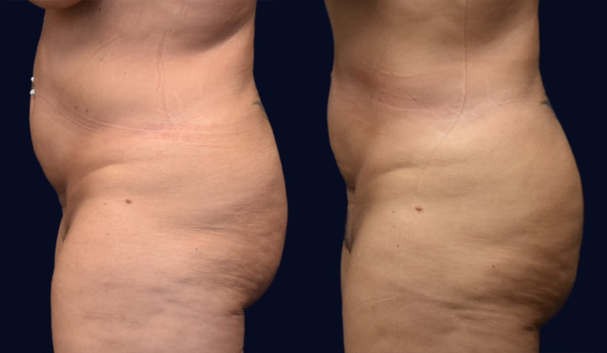 Liposuction Before & After Gallery - Patient 441727 - Image 2