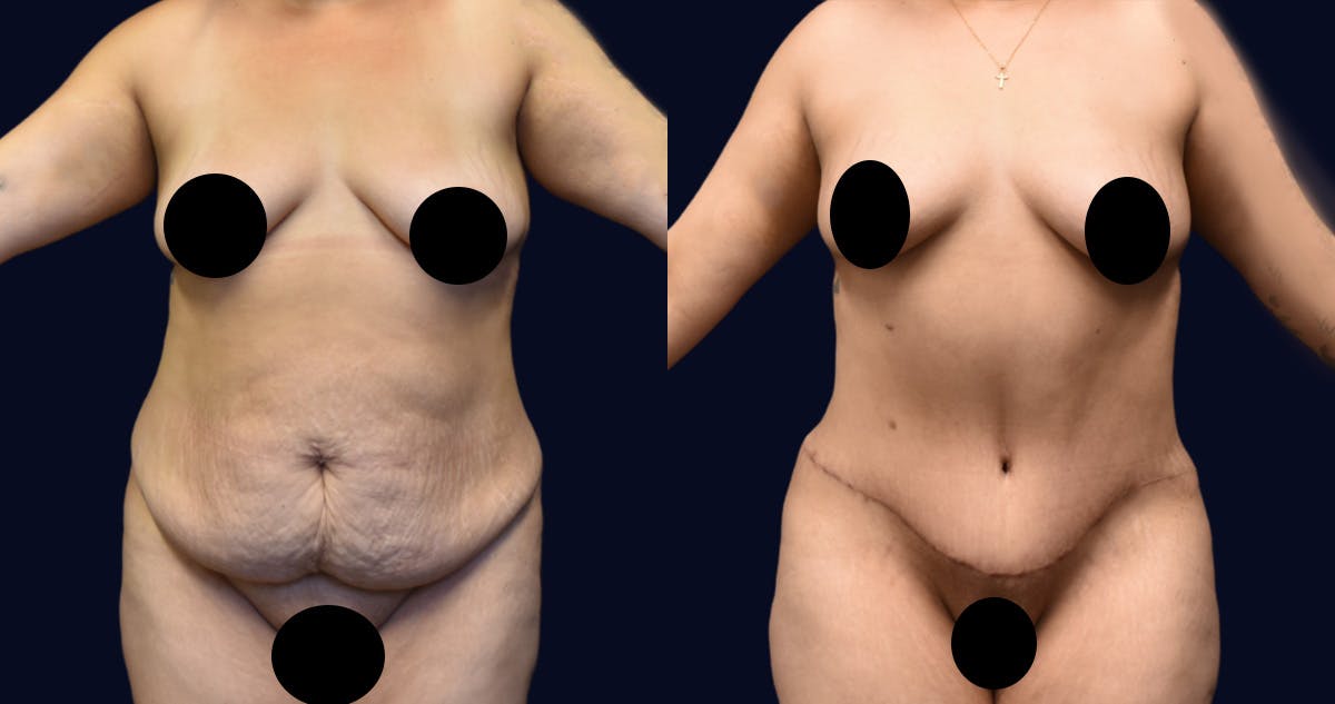 Abdominoplasty (Tummy Tuck) Before & After Gallery - Patient 389480 - Image 1