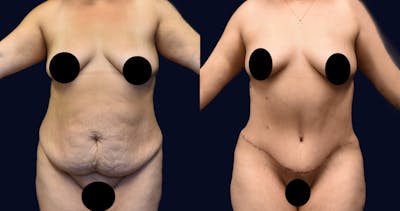 Abdominoplasty (Tummy Tuck) Before & After Gallery - Patient 389480 - Image 1