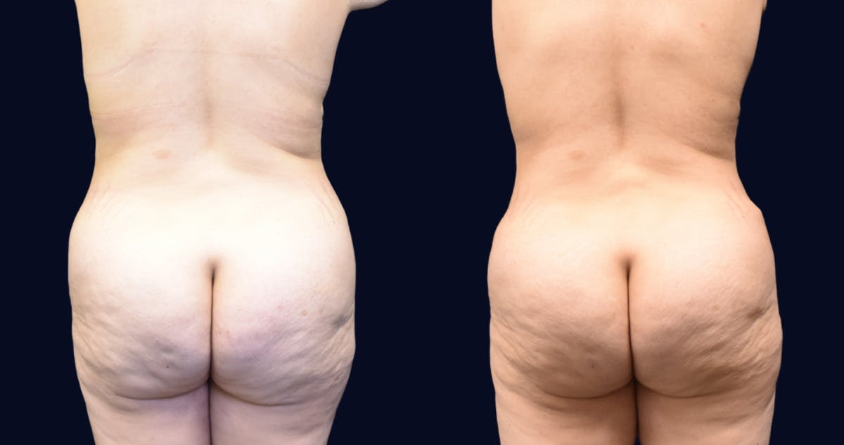 Abdominoplasty (Tummy Tuck) Before & After Gallery - Patient 389480 - Image 4
