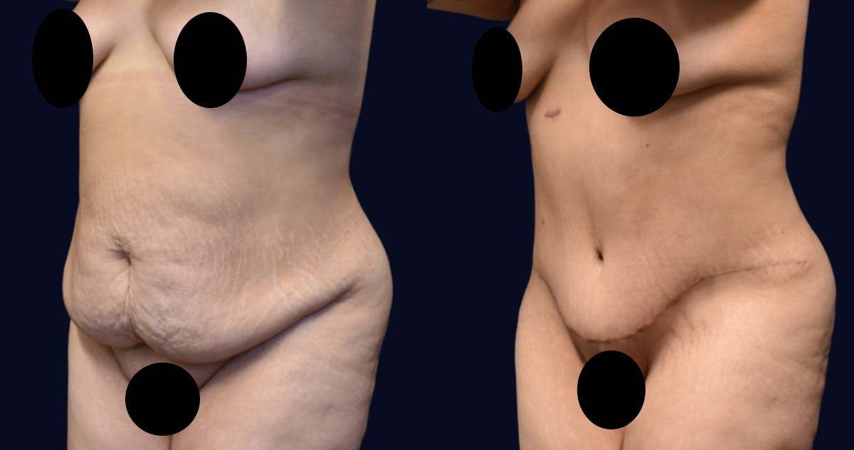 Abdominoplasty (Tummy Tuck) Before & After Gallery - Patient 389480 - Image 2