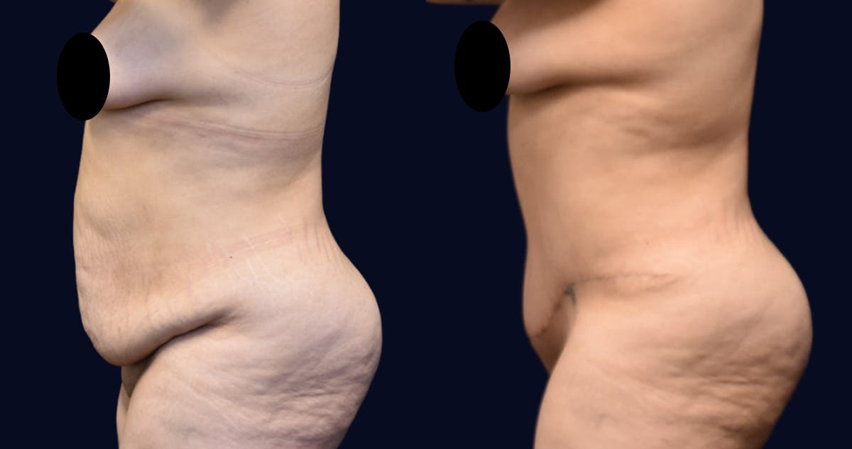 Abdominoplasty (Tummy Tuck) Before & After Gallery - Patient 389480 - Image 3