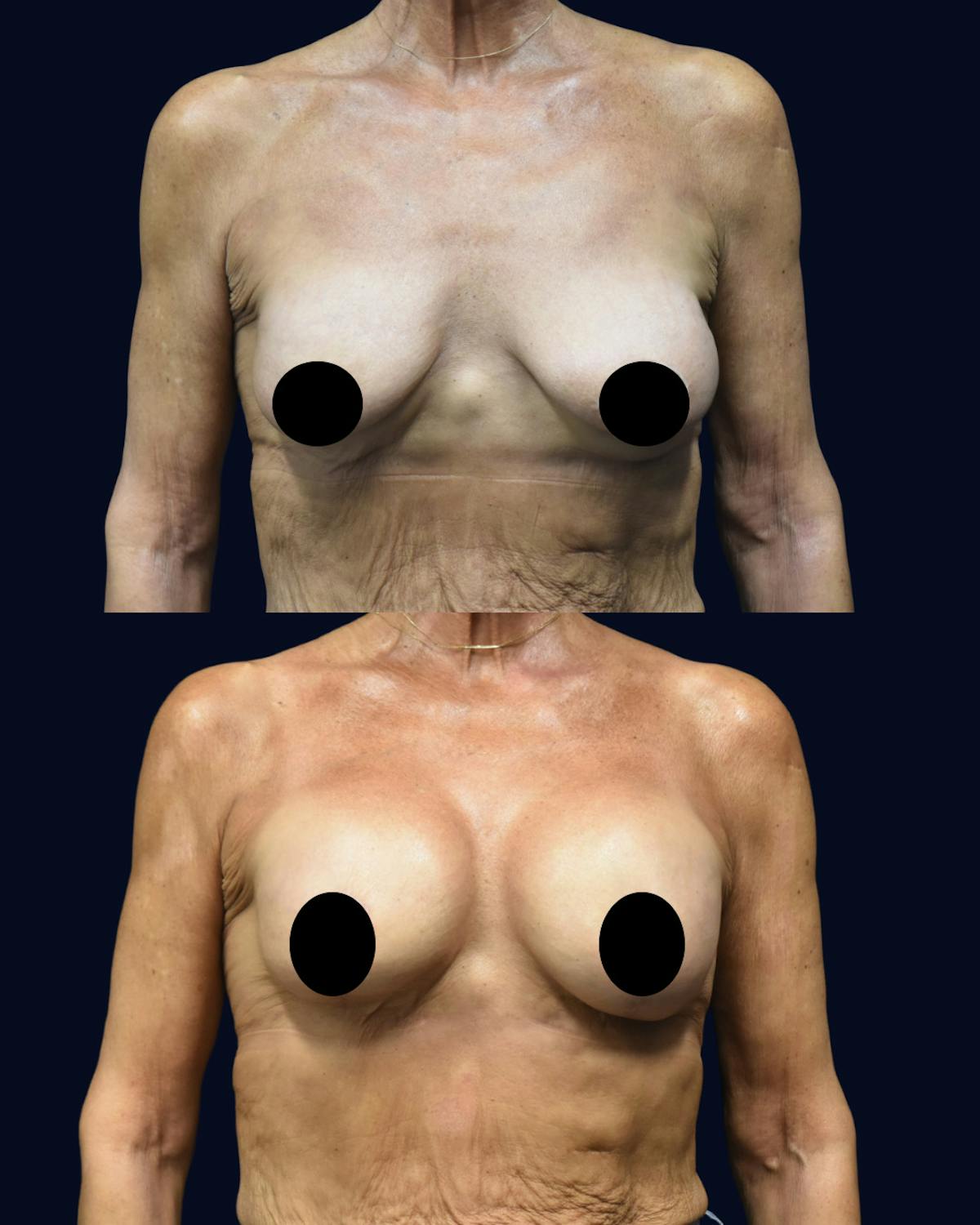 Breast Lift Before & After Gallery - Patient 557613 - Image 1