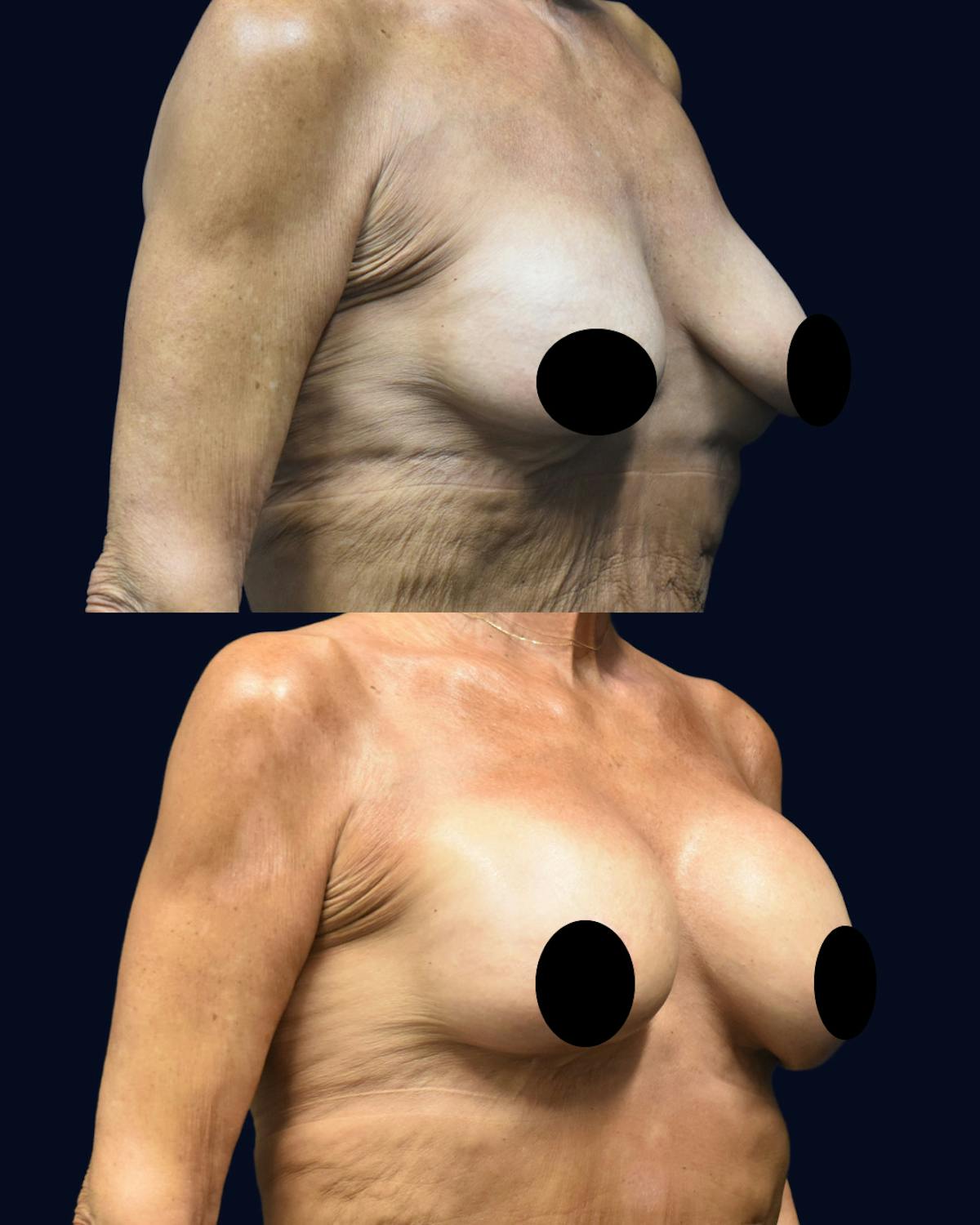 Breast Lift Before & After Gallery - Patient 557613 - Image 2