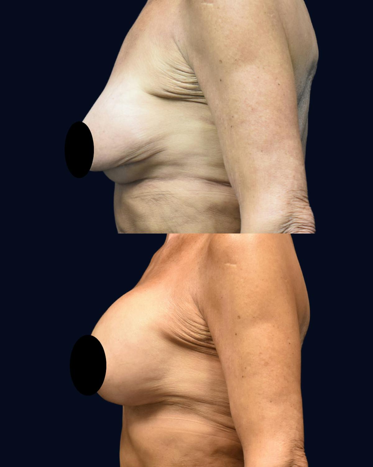 Breast Lift Before & After Gallery - Patient 557613 - Image 3