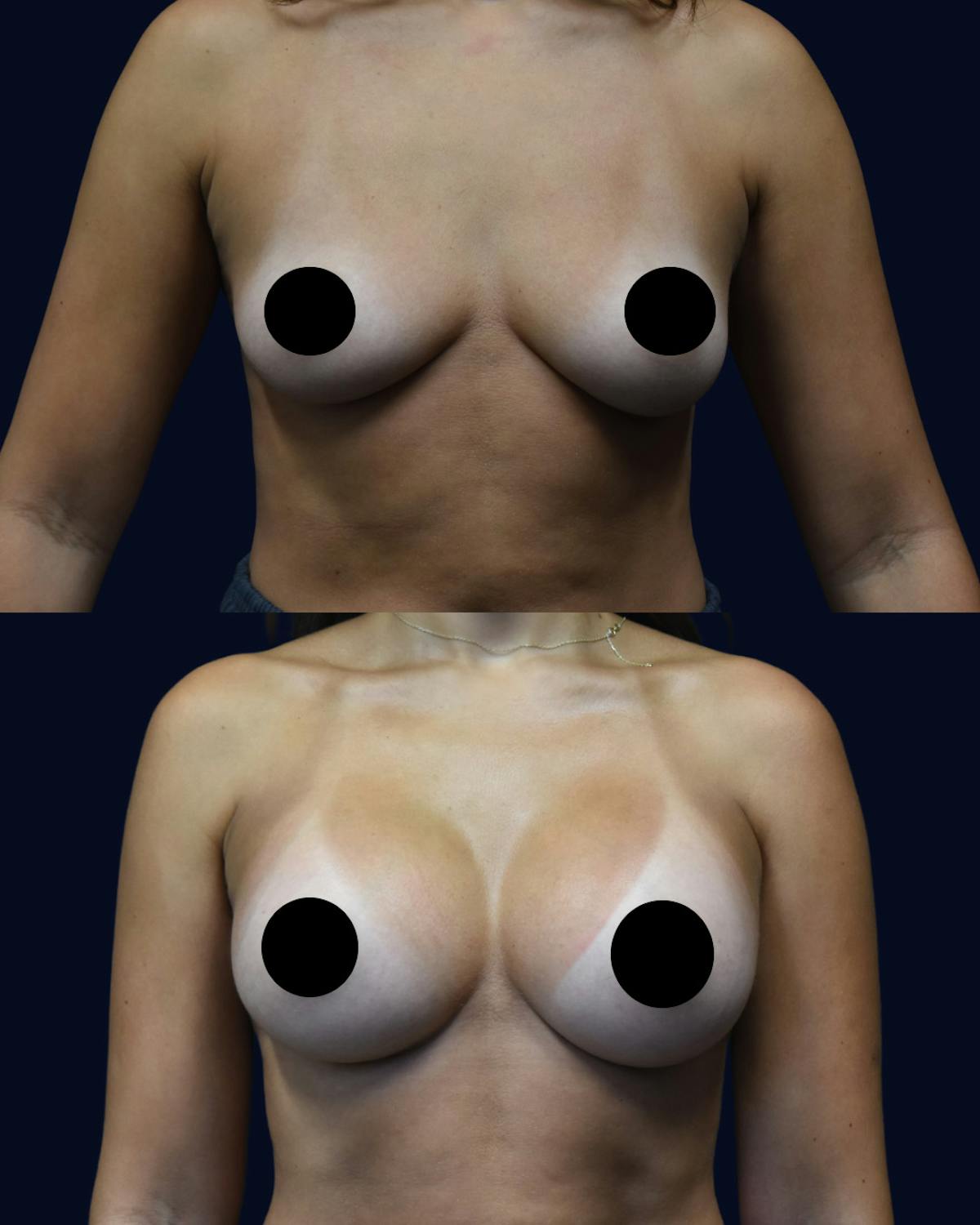 Breast Augmentation Before & After Gallery - Patient 102994 - Image 1