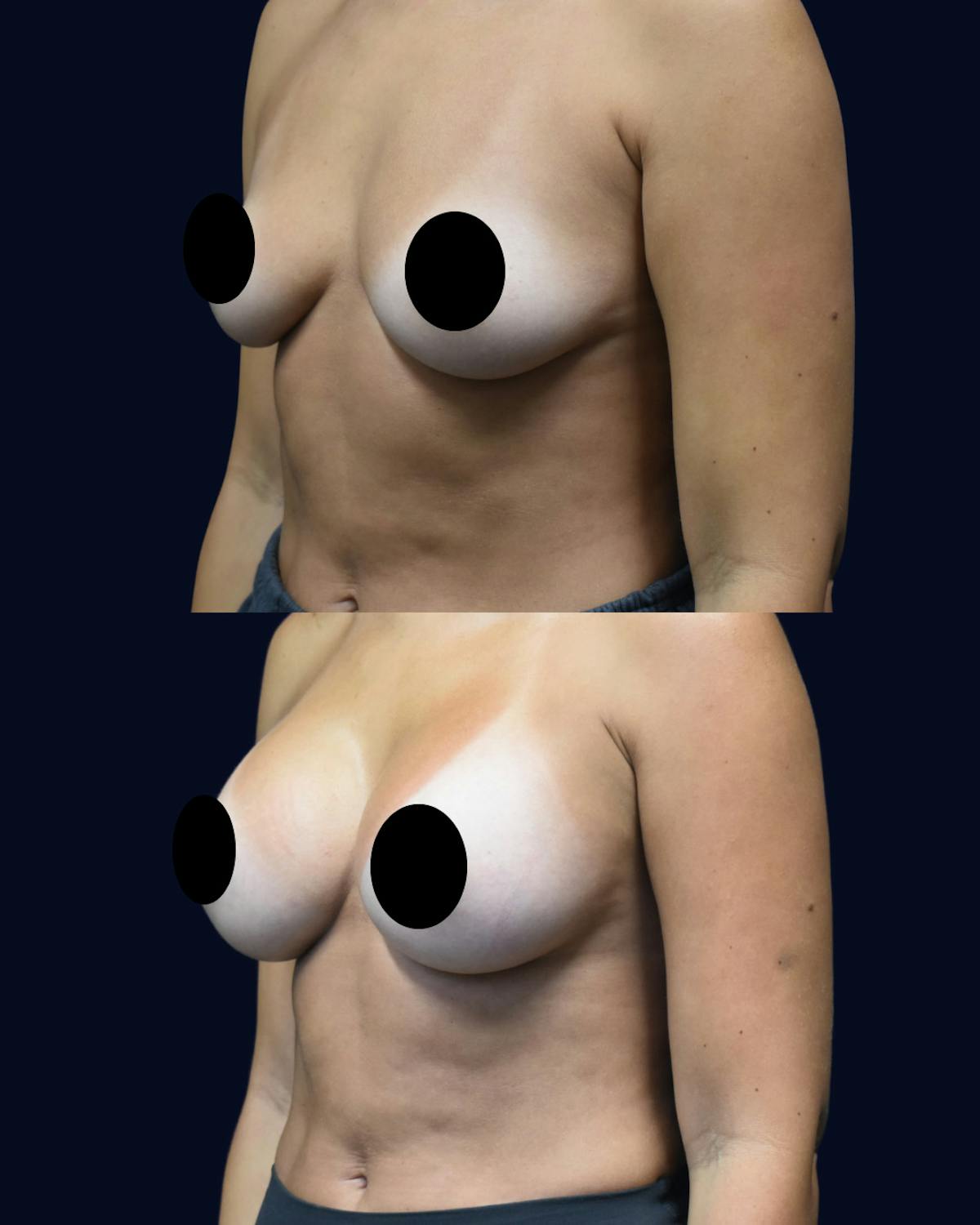 Breast Augmentation Before & After Gallery - Patient 102994 - Image 2