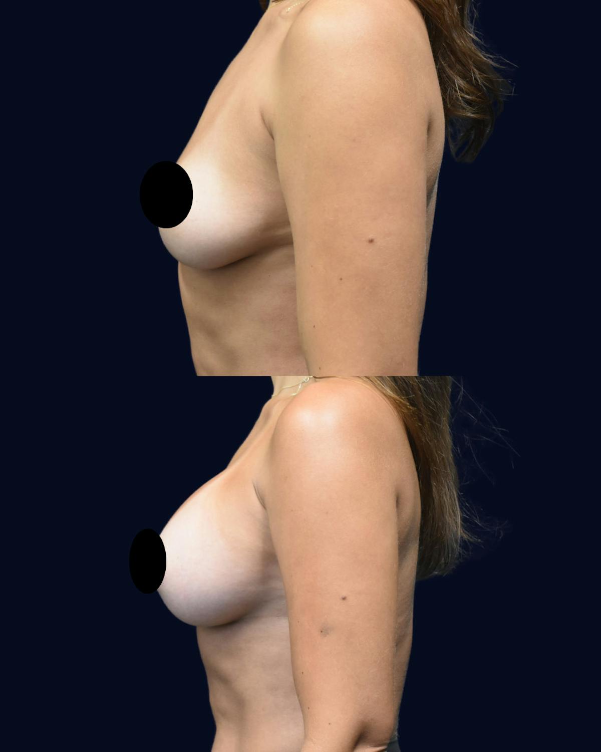 Breast Augmentation Before & After Gallery - Patient 102994 - Image 3