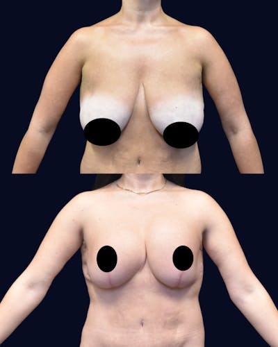 Breast Reduction Before & After Gallery - Patient 229133 - Image 1