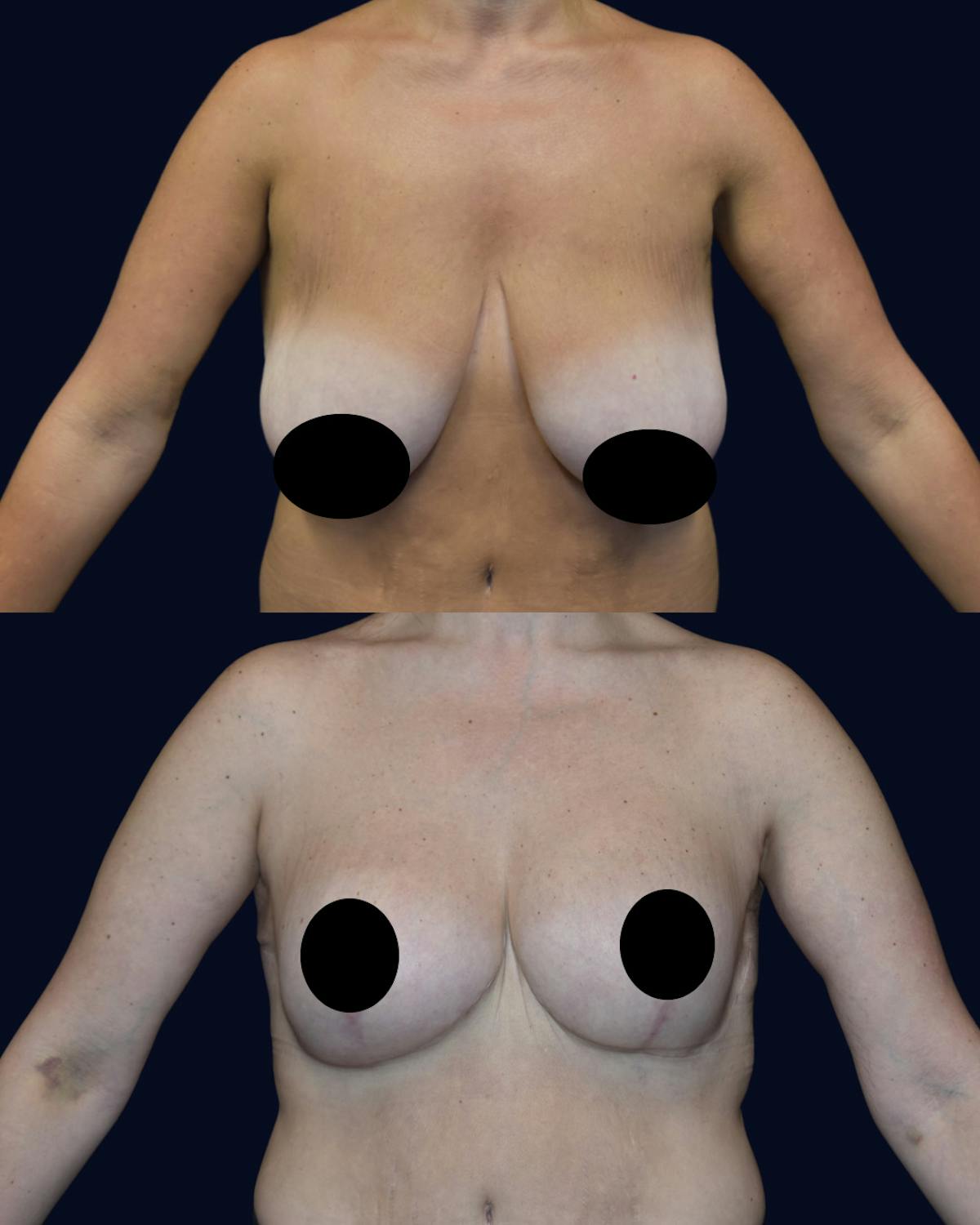 Breast Reduction Before & After Gallery - Patient 229133 - Image 2