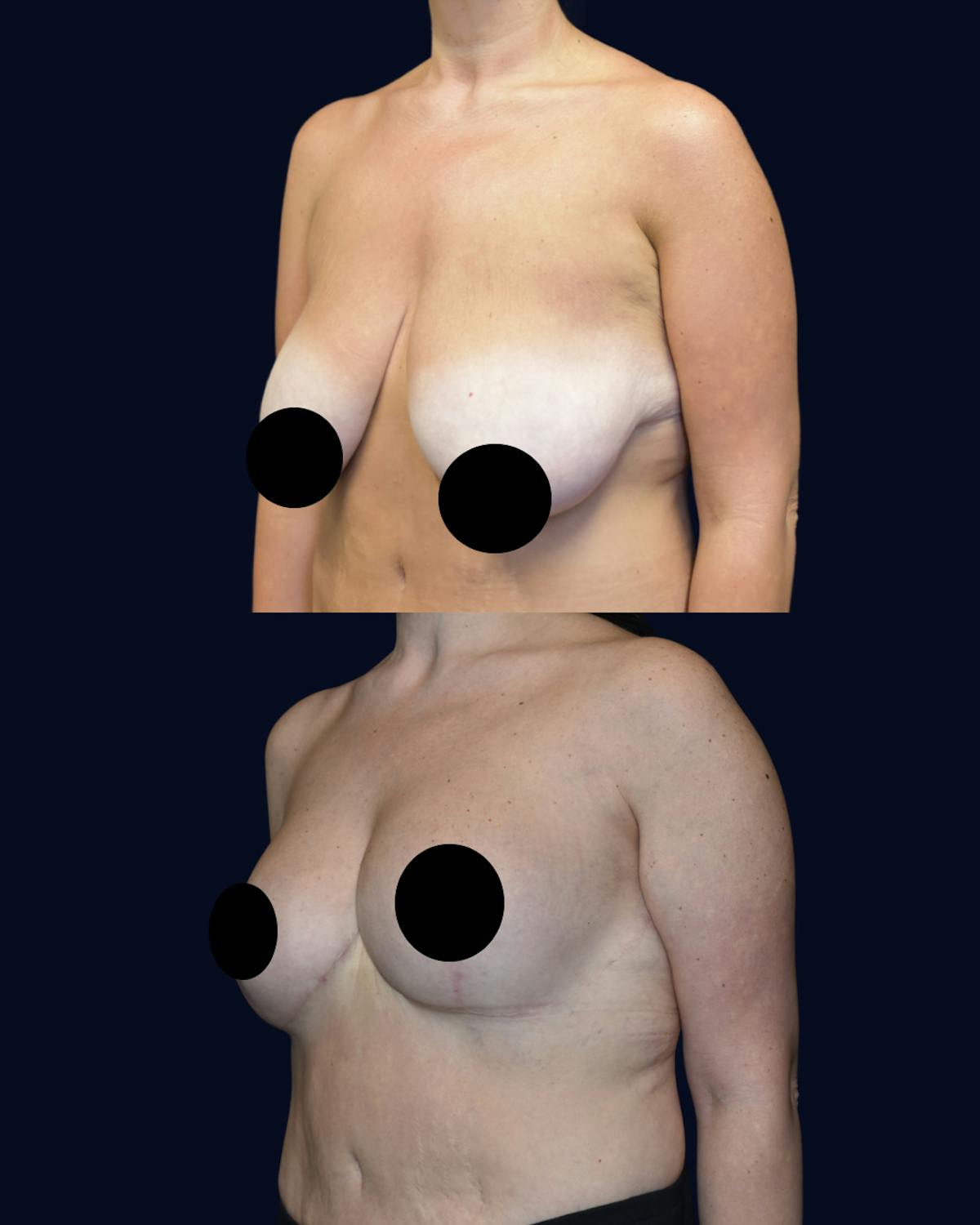 Breast Reduction Before & After Gallery - Patient 229133 - Image 3