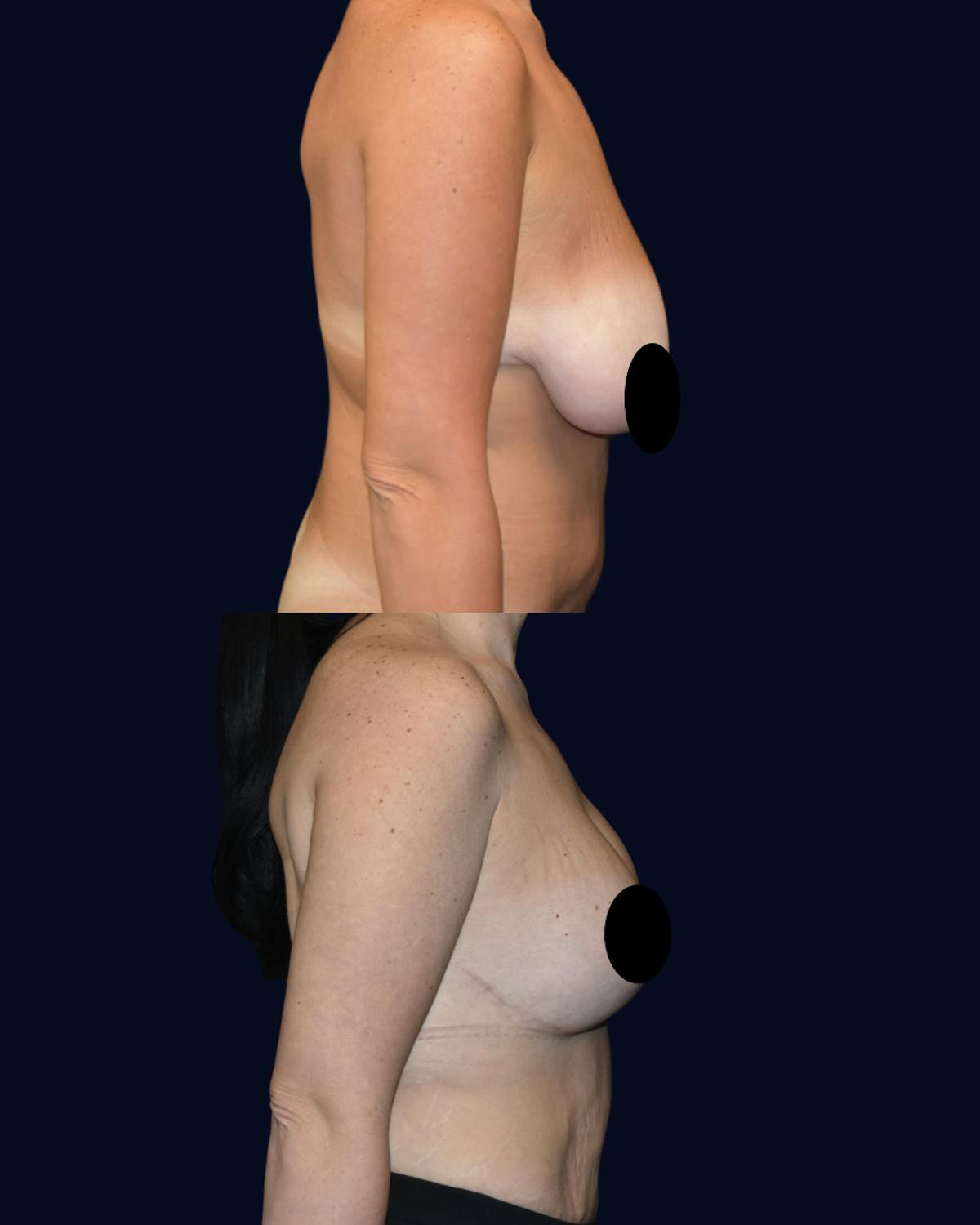 Breast Reduction Before & After Gallery - Patient 229133 - Image 4