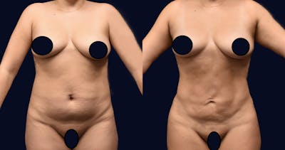 Abdominoplasty with Liposuction Before & After Gallery - Patient 764260 - Image 1