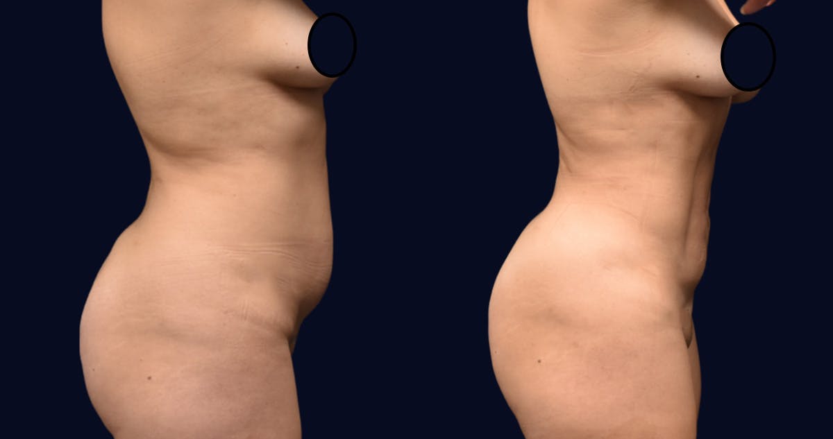 Liposuction Before & After Gallery - Patient 248055 - Image 3