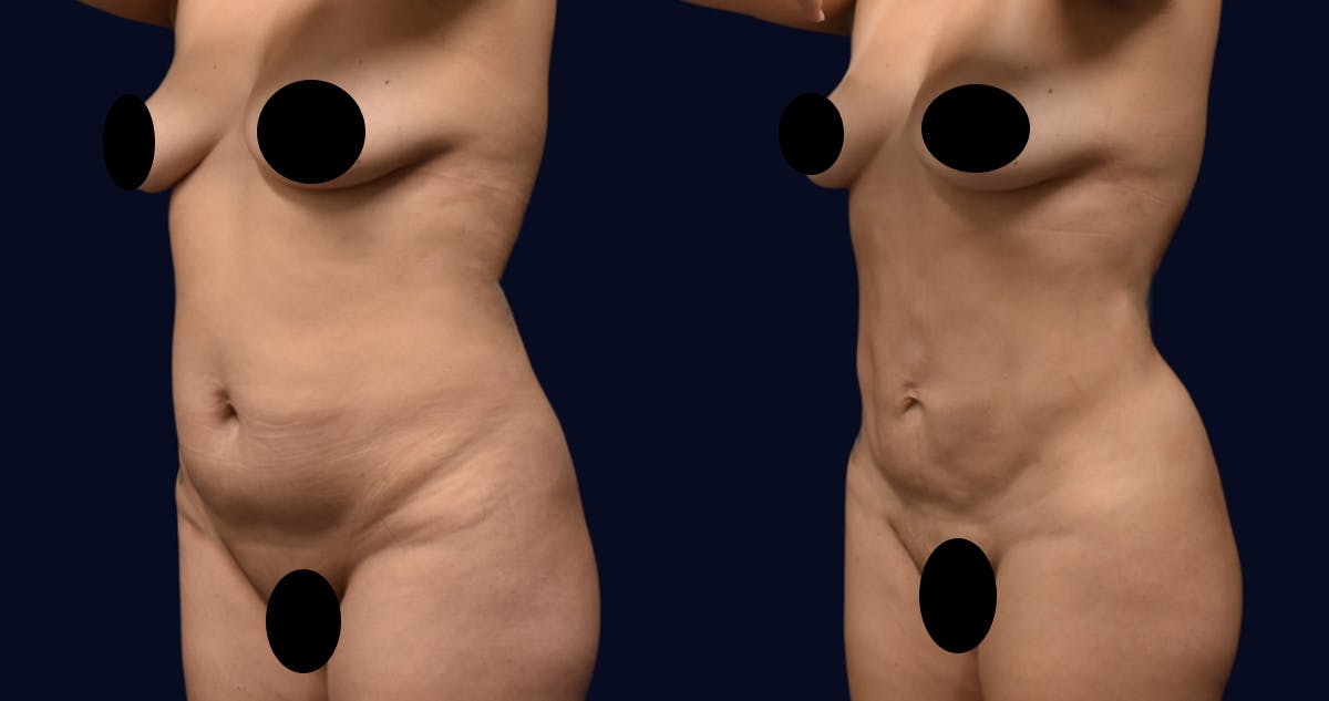 Liposuction Before & After Gallery - Patient 248055 - Image 2