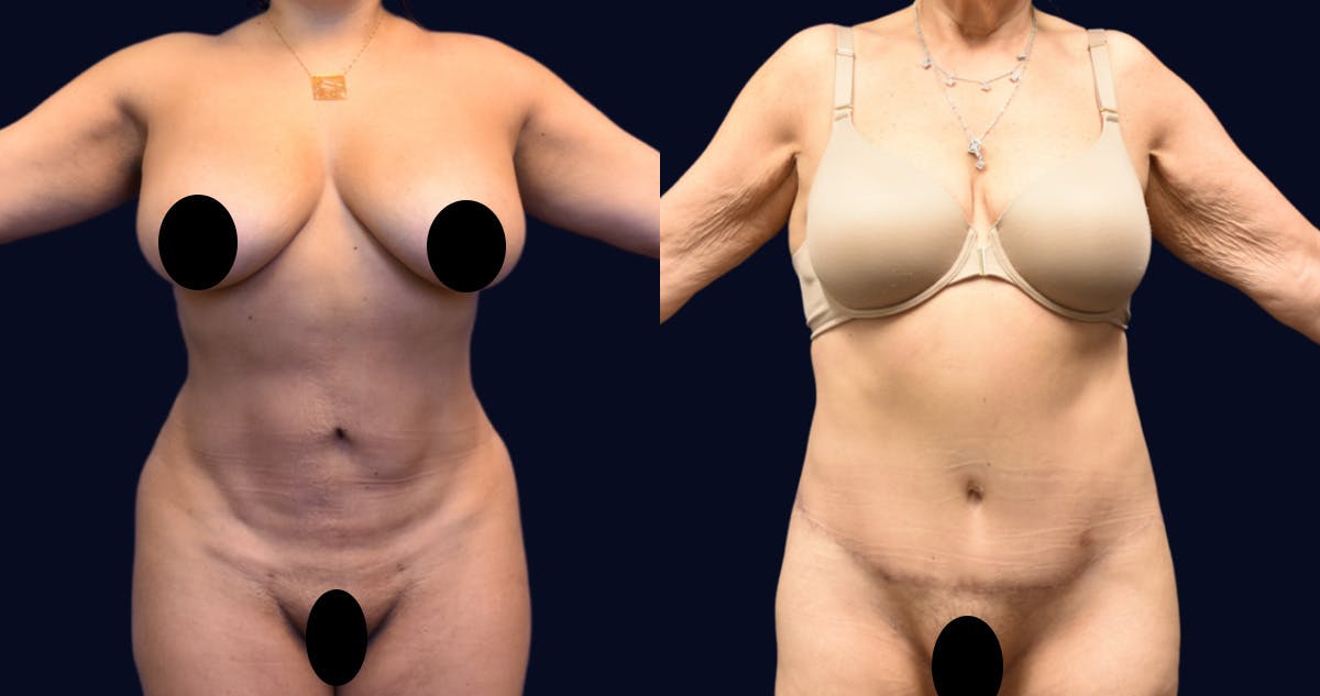 Liposuction Before & After Gallery - Patient 422944 - Image 2