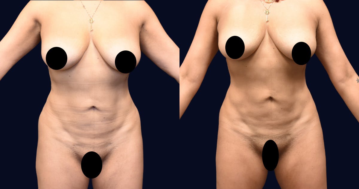 Liposuction Before & After Gallery - Patient 422944 - Image 1