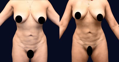 Abdominoplasty with Liposuction Before & After Gallery - Patient 367394 - Image 1