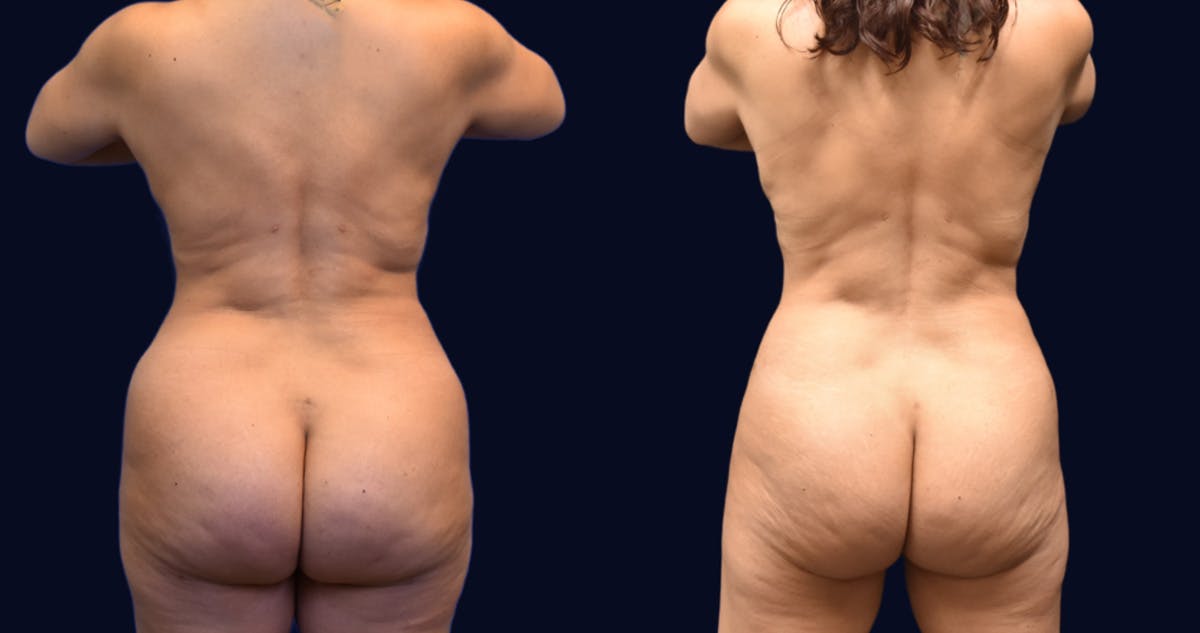 Liposuction Before & After Gallery - Patient 422944 - Image 5