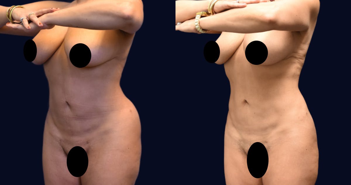 Liposuction Before & After Gallery - Patient 422944 - Image 3
