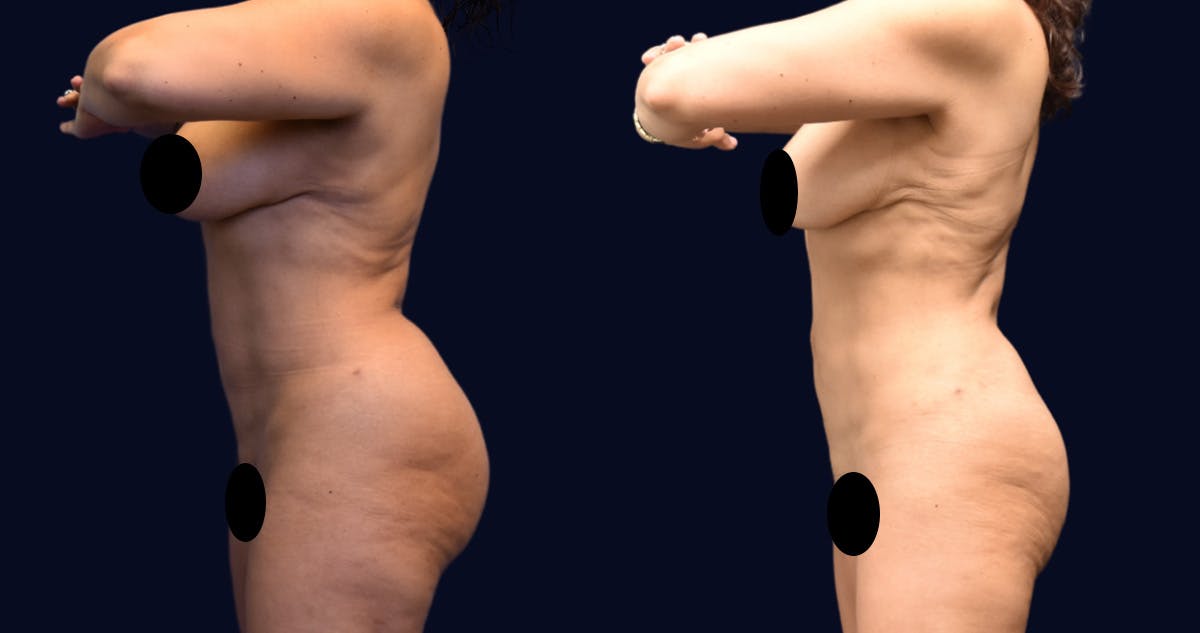 Liposuction Before & After Gallery - Patient 422944 - Image 4